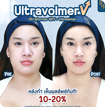 Ultravolmer V 1