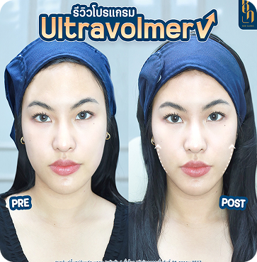 Ultravolmer V 10