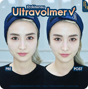 Ultravolmer V 12