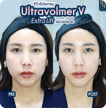 Ultravolmer V 13