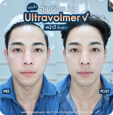 Ultravolmer V 15
