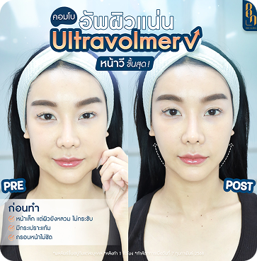 Ultravolmer V 18