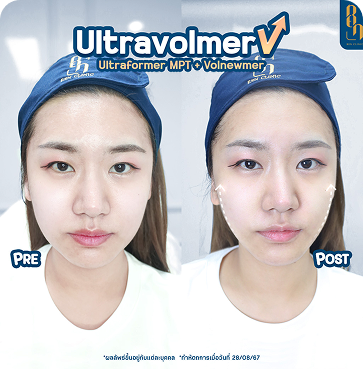 Ultravolmer V 3