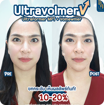 Ultravolmer V 4