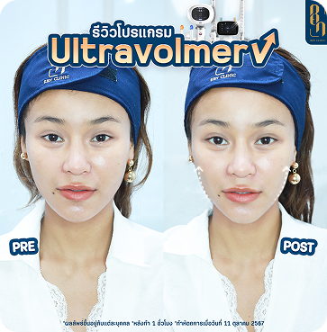 Ultravolmer V 6
