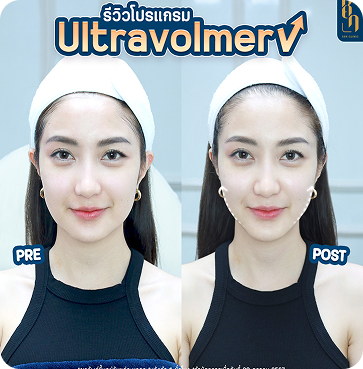 Ultravolmer V 7