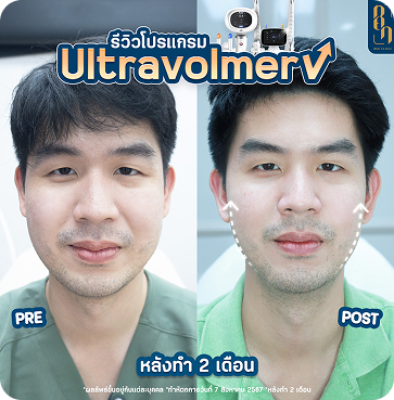 Ultravolmer V 8